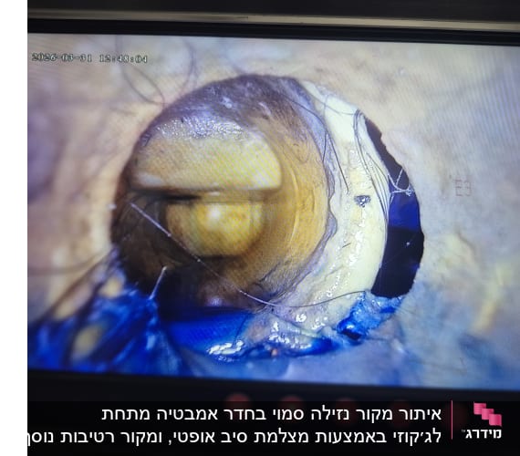 צילום פנים צינור עם סדק ותיקון כחול